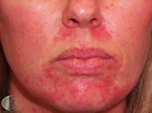 Perioral Dermatitis: Causes, Symptoms, and Treatment