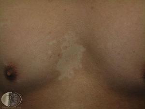 Pityriasis versicolor: causes and treatment