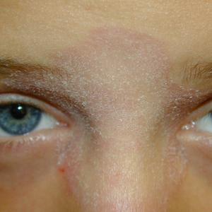 ringworm on forehead treatment