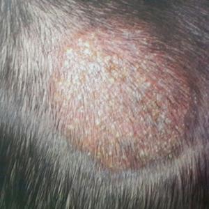 What Is Tinea Capitis?