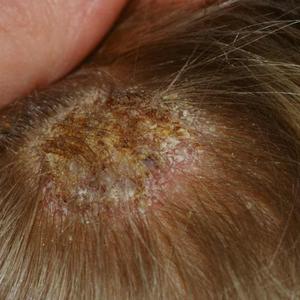 Tinea capitis (scalp ringworm) - HSE.ie