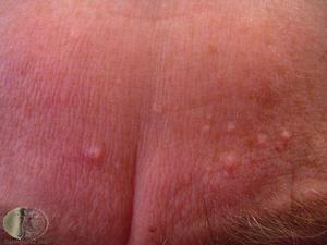 sebaceous glands bumps